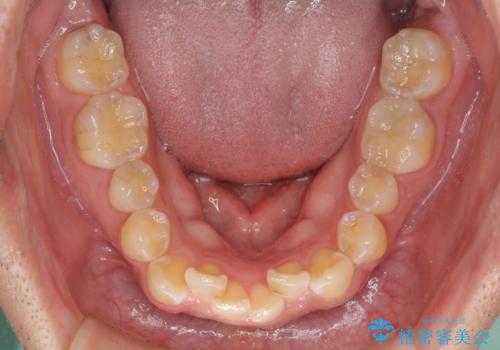 ディープバイトと叢生を解消 インビザライン矯正の治療前