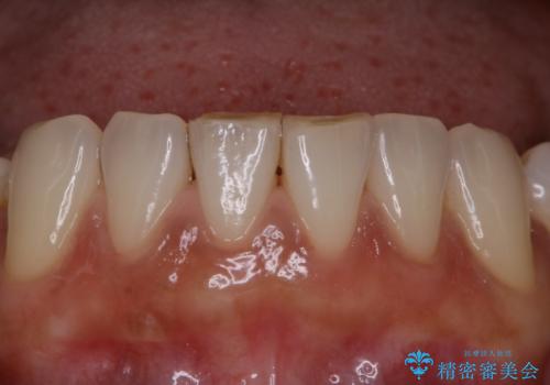 全体の総合的な治療前にPMTCの治療後