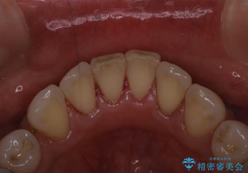 全体の総合的な治療前にPMTCの治療後