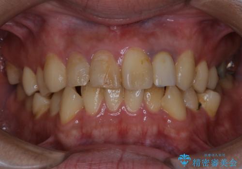 人生で初めて歯のクリーニング〔PMTC〕の治療前