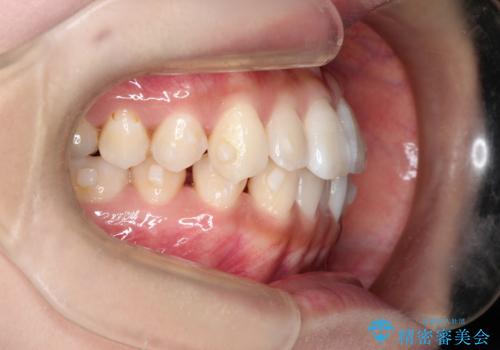 前歯のがたつきと反対咬合　インビザラインによる矯正治療の治療中