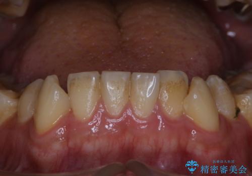 人生で初めて歯のクリーニング〔PMTC〕の症例 治療前