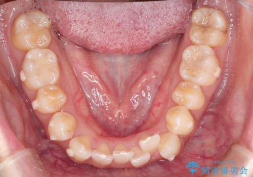 前歯のがたつきと反対咬合　インビザラインによる矯正治療の治療中