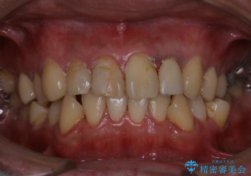 人生で初めて歯のクリーニング〔PMTC〕の治療後