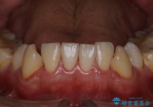 人生で初めて歯のクリーニング〔PMTC〕の症例 治療後