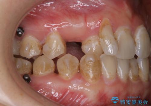 インビザライン矯正中にPMTCでコーヒーによるステインの除去の治療前