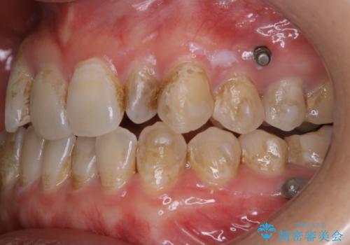 インビザライン矯正中にPMTCでコーヒーによるステインの除去の治療前