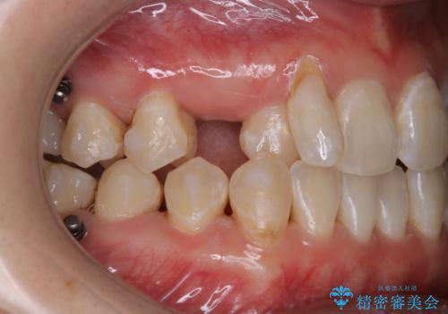 インビザライン矯正中にPMTCでコーヒーによるステインの除去の治療後
