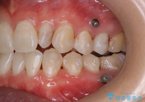 インビザライン矯正中にPMTCでコーヒーによるステインの除去の治療後