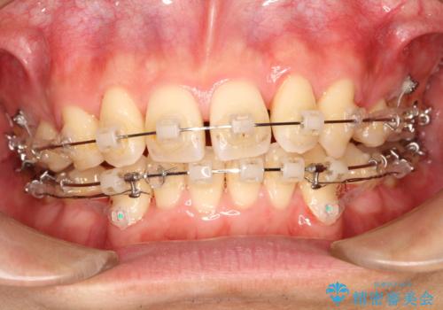 前歯のガタガタをきれいにしたい ワイヤーによる抜歯矯正で整った歯並びへの治療中