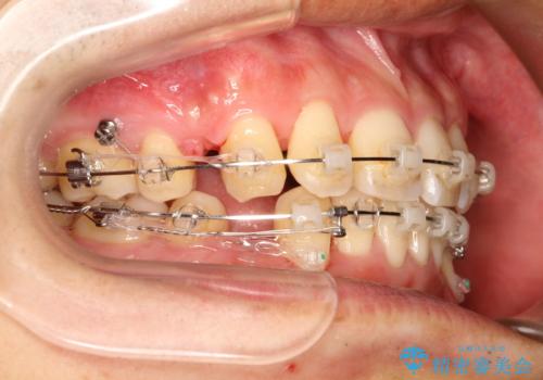 前歯のガタガタをきれいにしたい　ワイヤーによる抜歯矯正で整った歯並びへの治療中