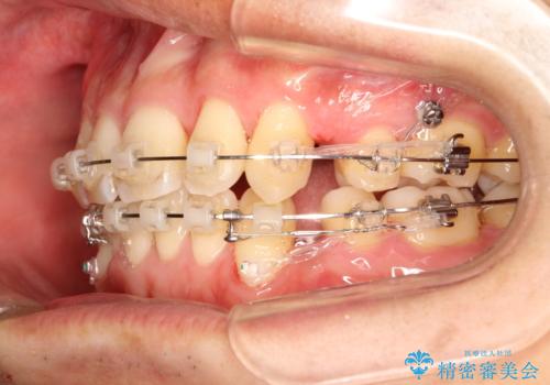 前歯のガタガタをきれいにしたい　ワイヤーによる抜歯矯正で整った歯並びへの治療中
