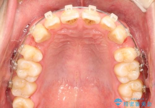 前歯のガタガタをきれいにしたい ワイヤーによる抜歯矯正で整った歯並びへの治療中