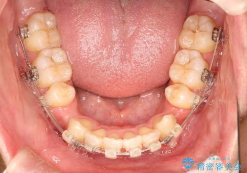 前歯のガタガタをきれいにしたい ワイヤーによる抜歯矯正で整った歯並びへの治療中