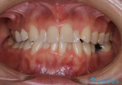 矯正治療の開始前にPMTCで汚れの除去の治療前