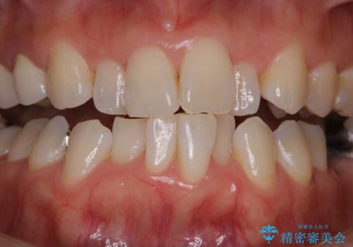 矯正治療の開始前にPMTCで汚れの除去の治療前