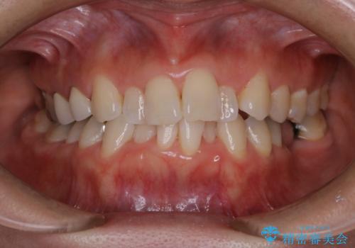 矯正治療の開始前にPMTCで汚れの除去の治療後