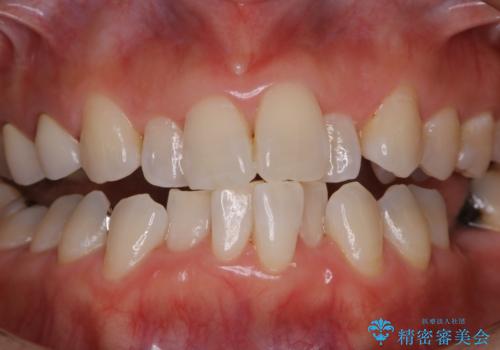 矯正治療の開始前にPMTCで汚れの除去の治療後