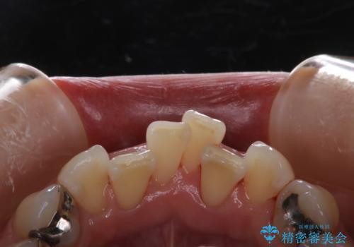矯正治療の開始前にPMTCで汚れの除去の症例 治療後
