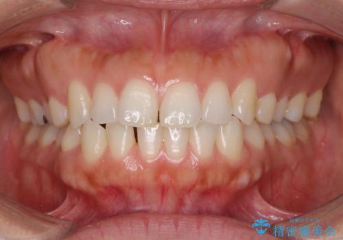 受け口傾向の前歯　すきっ歯の改善の治療前