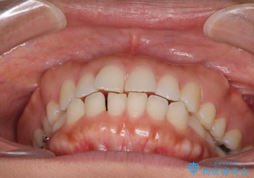 受け口傾向の前歯 すきっ歯の改善の治療前