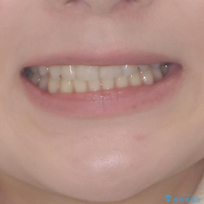 八重歯を短期間で改善　ワイヤー装置による抜歯矯正の治療後（顔貌）
