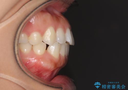 受け口傾向の前歯　すきっ歯の改善の治療前