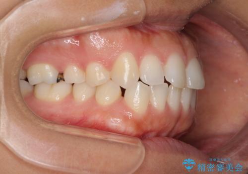 受け口傾向の前歯 すきっ歯の改善の治療前
