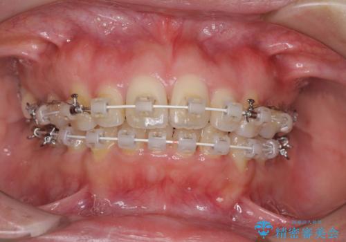 口元をスッキリと ワイヤー装置による抜歯矯正の治療中