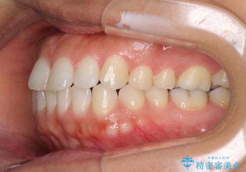受け口傾向の前歯 すきっ歯の改善の治療前
