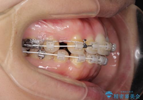 口元をスッキリと　ワイヤー装置による抜歯矯正の治療中