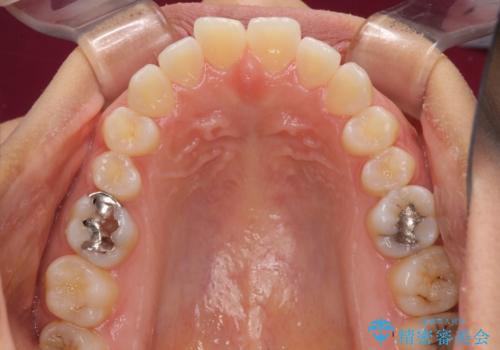 受け口傾向の前歯 すきっ歯の改善の治療前