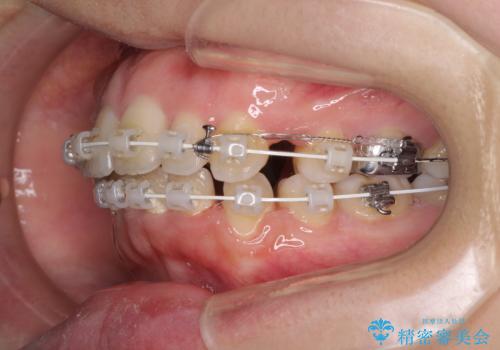 口元をスッキリと　ワイヤー装置による抜歯矯正の治療中