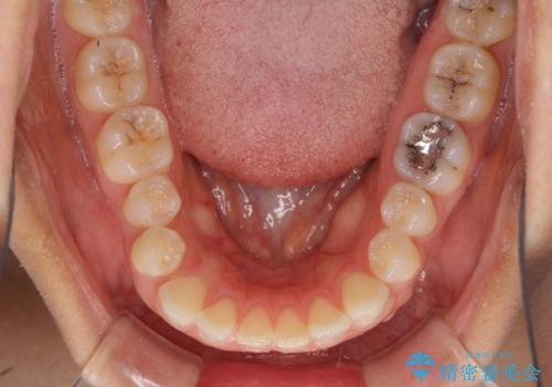受け口傾向の前歯 すきっ歯の改善の治療前