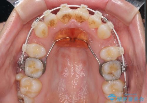 口元をスッキリと ワイヤー装置による抜歯矯正の治療中