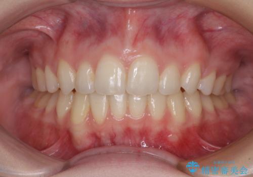 八重歯を短期間で改善　ワイヤー装置による抜歯矯正