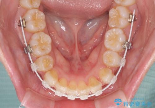 口元をスッキリと ワイヤー装置による抜歯矯正の治療中