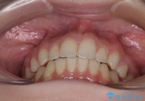 八重歯を短期間で改善　ワイヤー装置による抜歯矯正の治療後