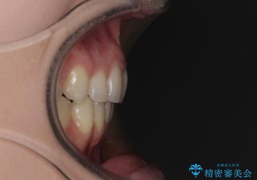 八重歯を短期間で改善 ワイヤー装置による抜歯矯正の治療後