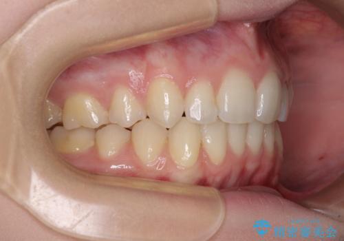 八重歯を短期間で改善 ワイヤー装置による抜歯矯正の治療後