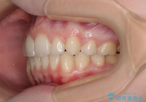 八重歯を短期間で改善 ワイヤー装置による抜歯矯正の治療後