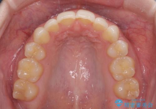 八重歯を短期間で改善 ワイヤー装置による抜歯矯正の治療後