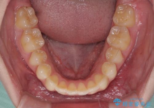 八重歯を短期間で改善 ワイヤー装置による抜歯矯正の治療後