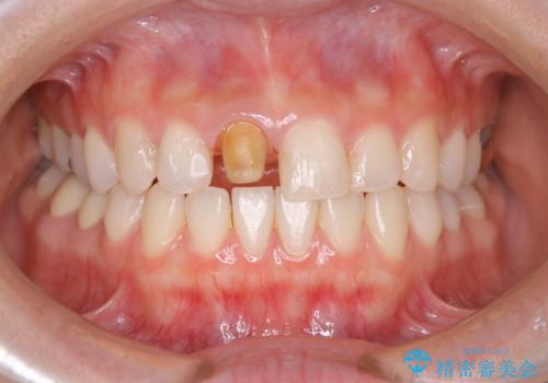 前歯1本だけ色が違う:他の歯となじむ被せ物で自然な仕上がりにの治療中