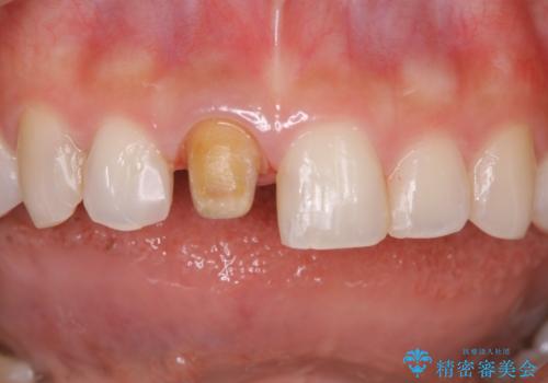 前歯1本だけ色が違う:他の歯となじむ被せ物で自然な仕上がりにの治療中
