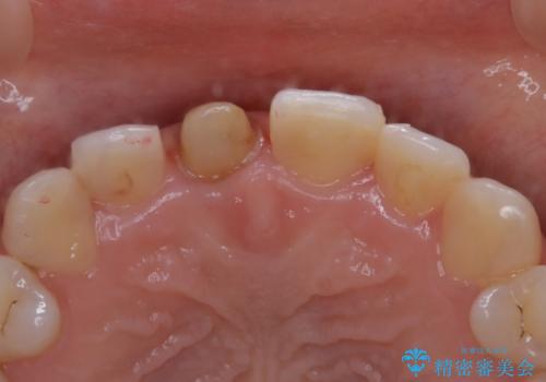 前歯1本だけ色が違う:他の歯となじむ被せ物で自然な仕上がりにの治療中