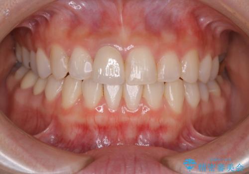 前歯1本だけ色が違う:他の歯となじむ被せ物で自然な仕上がりにの治療後