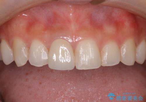 前歯1本だけ色が違う:他の歯となじむ被せ物で自然な仕上がりにの治療後