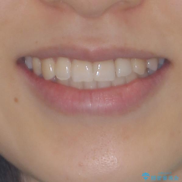 前歯のクロスバイト　インビザラインによる矯正治療の治療後（顔貌）