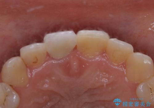 前歯1本だけ色が違う:他の歯となじむ被せ物で自然な仕上がりにの治療後